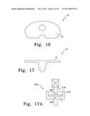 Orthopaedic Component Manufacturing Method and Equipment diagram and image