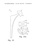 Orthopaedic Component Manufacturing Method and Equipment diagram and image