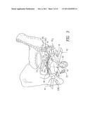 METHOD AND APPARATUS FOR TREATING PELVIC ORGAN PROLAPSES IN FEMALE     PATIENTS diagram and image