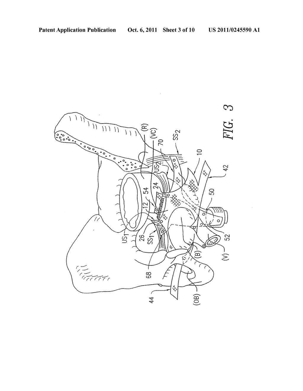 METHOD AND APPARATUS FOR TREATING PELVIC ORGAN PROLAPSES IN FEMALE     PATIENTS - diagram, schematic, and image 04