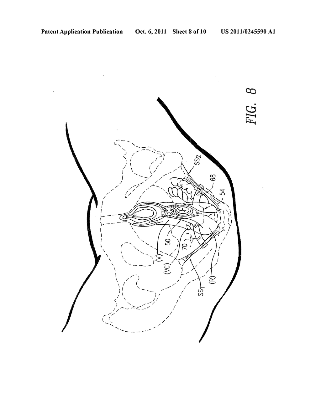 METHOD AND APPARATUS FOR TREATING PELVIC ORGAN PROLAPSES IN FEMALE     PATIENTS - diagram, schematic, and image 09