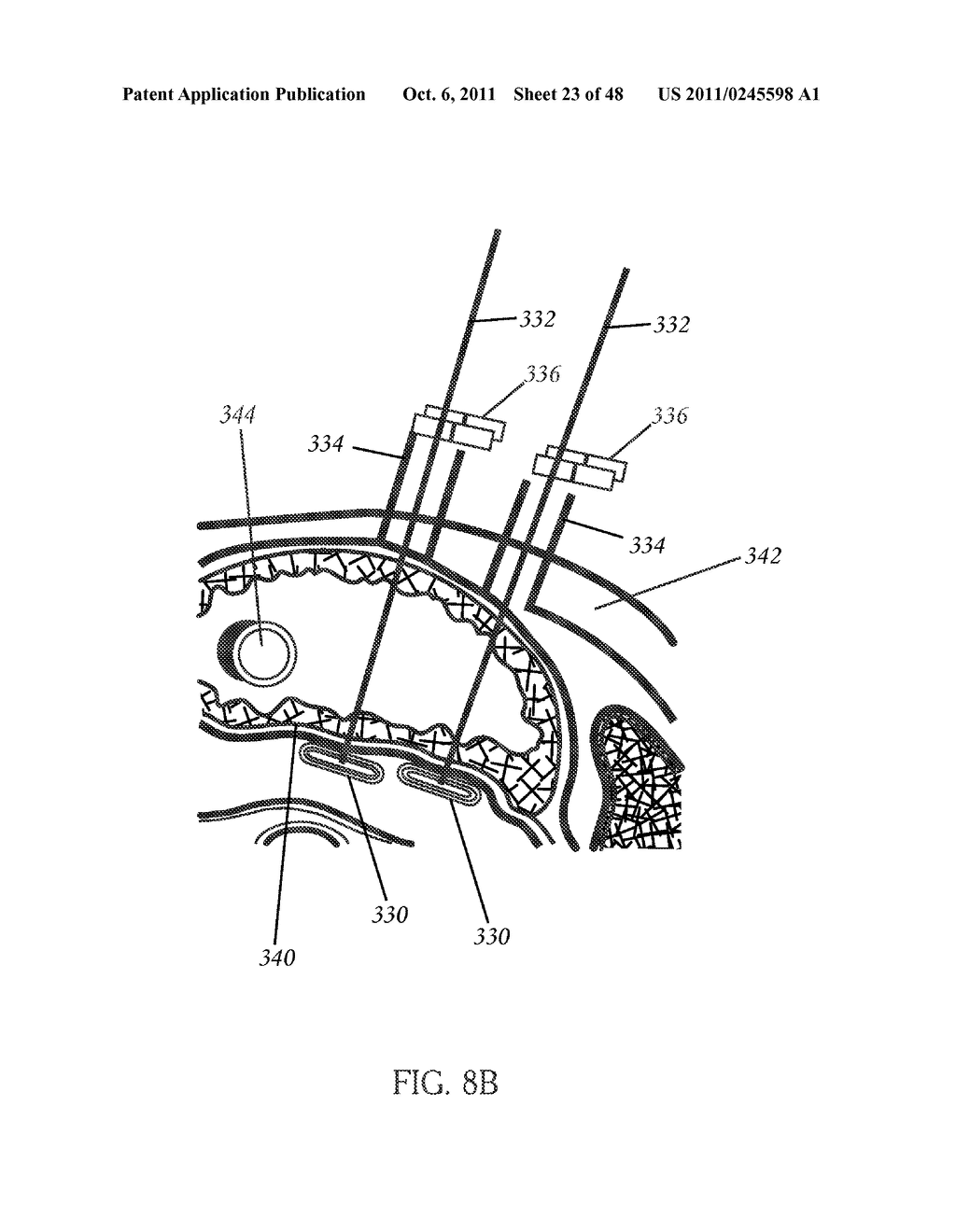 CLOSED LOOP GASTRIC RESTRICTION DEVICES AND METHODS - diagram, schematic, and image 24