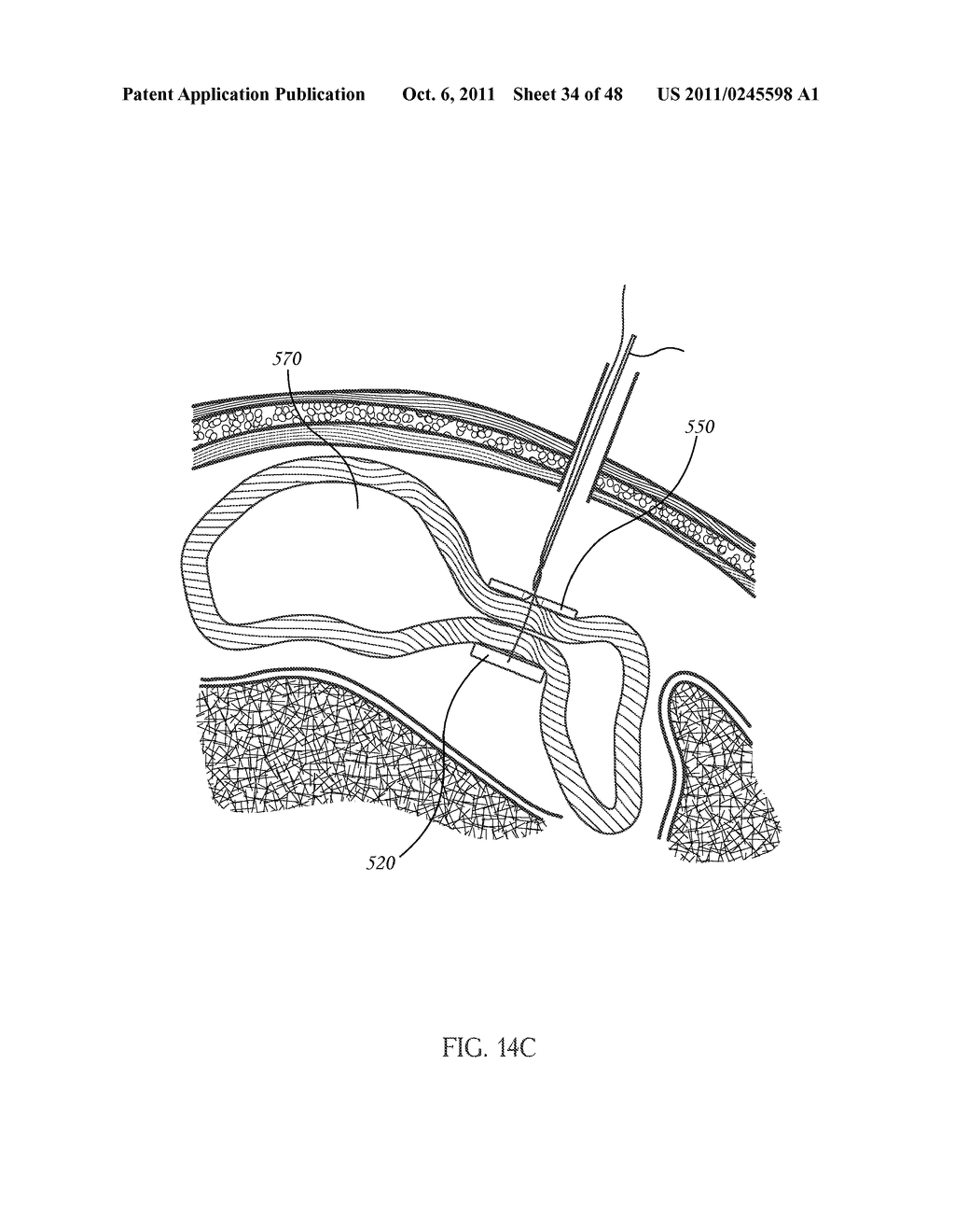 CLOSED LOOP GASTRIC RESTRICTION DEVICES AND METHODS - diagram, schematic, and image 35