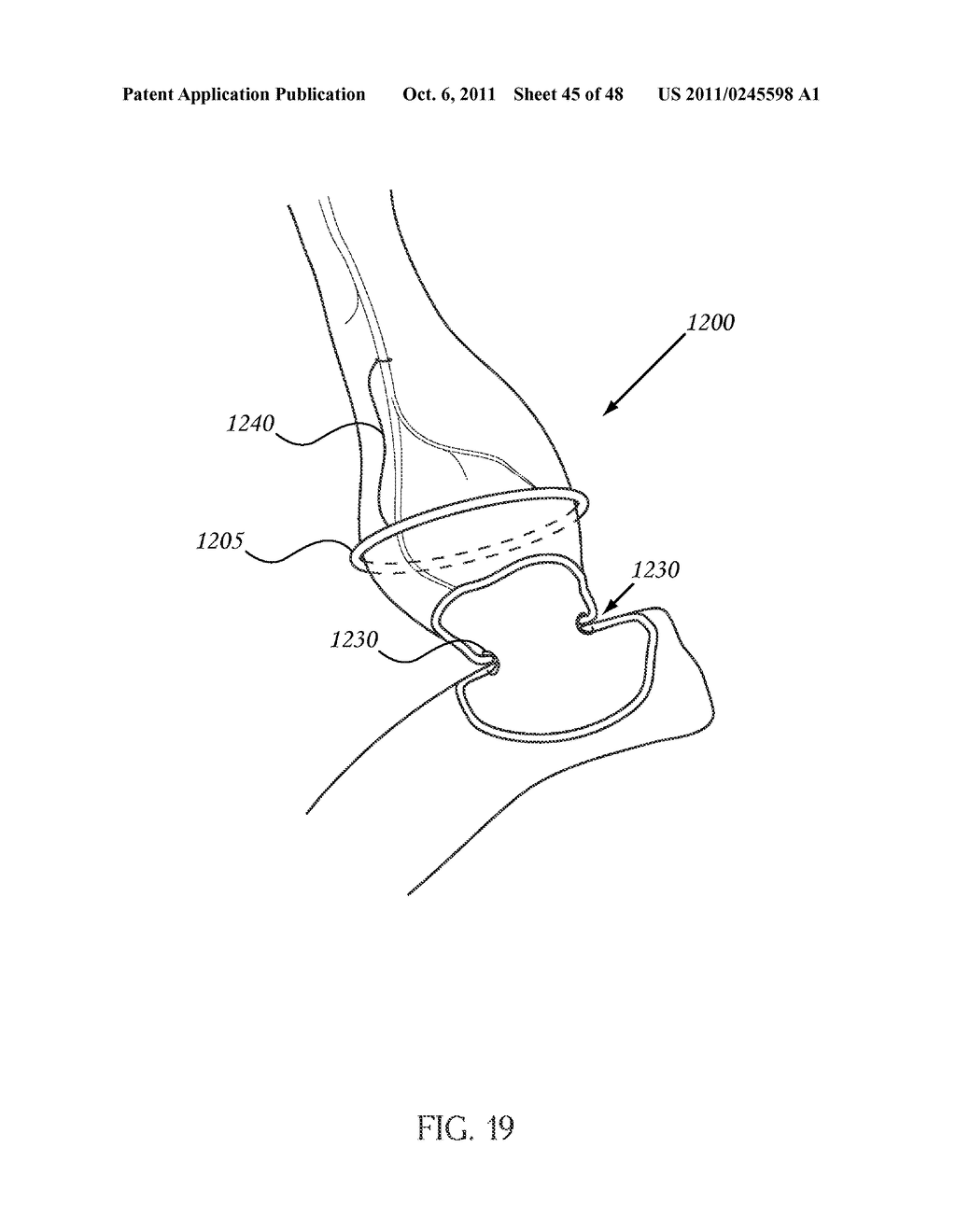 CLOSED LOOP GASTRIC RESTRICTION DEVICES AND METHODS - diagram, schematic, and image 46