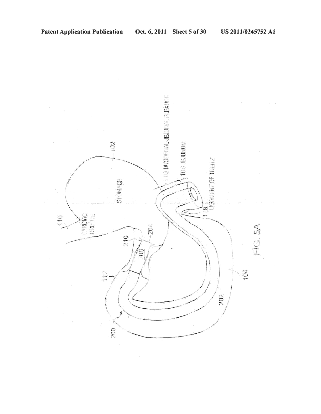 METHODS OF TREATMENT USING A BARIATRIC SLEEVE - diagram, schematic, and image 06