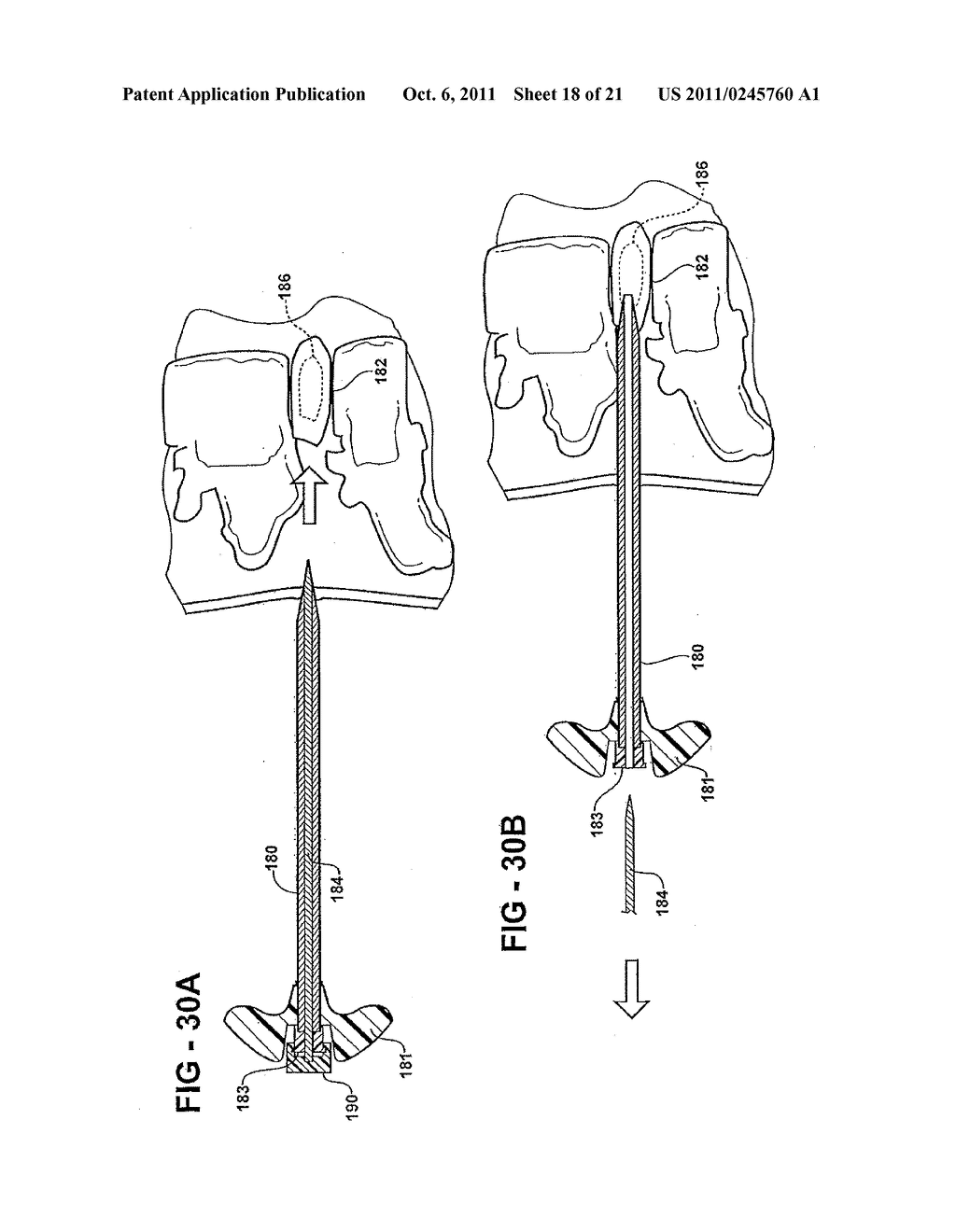 SYSTEM FOR USE DURING DISCOGRAPHY TO WIRELESSLY TRANSMIT DATA FROM     HAND-HELD FLUID DELIVERY DEVICE INSIDE STERILE FIELD TO DEVICE OUTSIDE     STERILE FIELD - diagram, schematic, and image 19