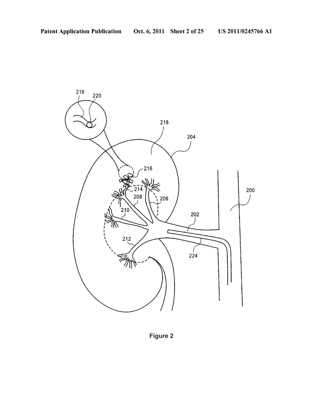 Method and Apparatus for Improving Delivery of an Agent to a Kidney - diagram, schematic, and image 03