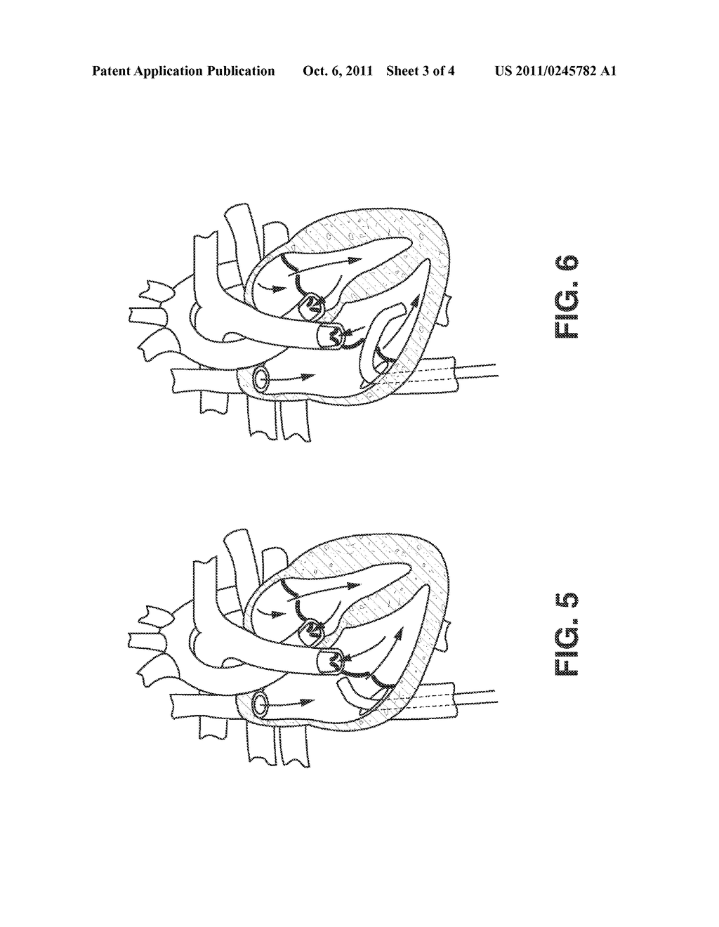 Method of Using Catheter with Rotating Portion - diagram, schematic, and image 04