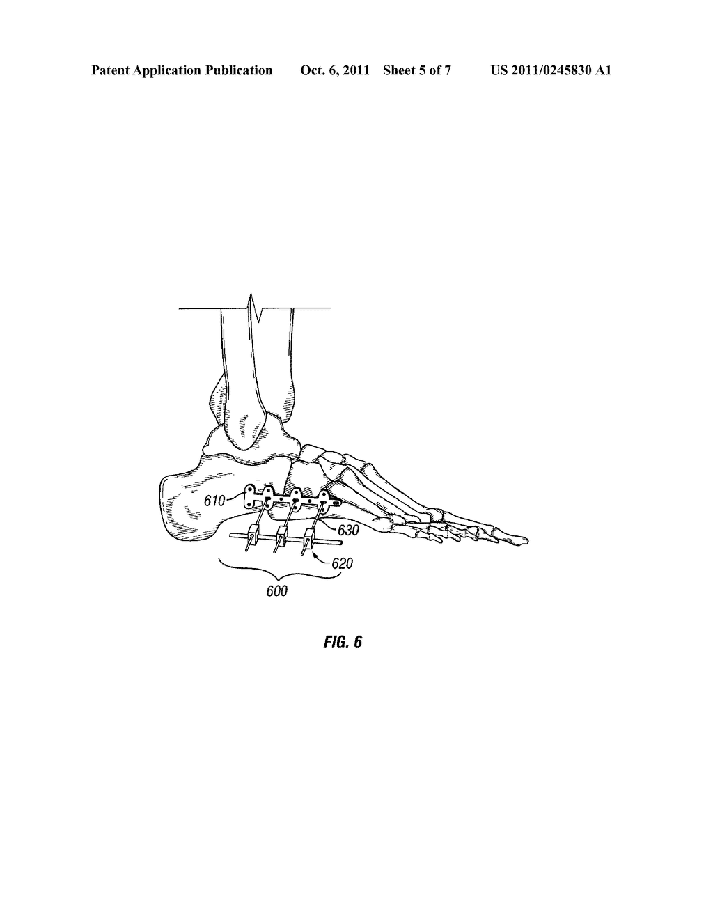 FOOT, ANKLE AND LOWER EXTREMITY COMPRESSION AND FIXATION SYSTEM AND     RELATED USES - diagram, schematic, and image 06