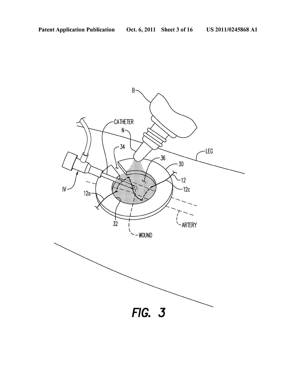 Vascular Access Wound Sealing System and Method - diagram, schematic, and image 04