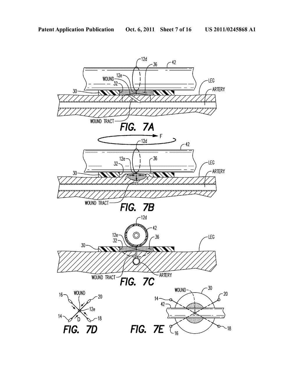 Vascular Access Wound Sealing System and Method - diagram, schematic, and image 08