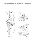 Rod and plate system for incremental reduction of the spine diagram and image