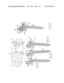 Rod and plate system for incremental reduction of the spine diagram and image