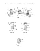 RETENTION MECHANISMS FOR ROD LOCKING SET SCREWS diagram and image