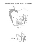 DENTIN ANCHOR diagram and image