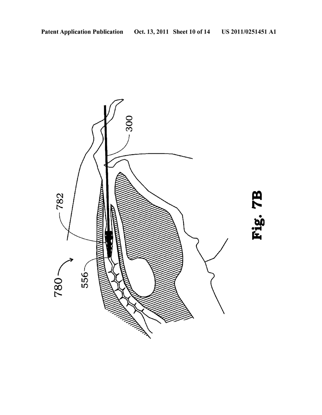 METHOD AND APPARATUS FOR CREATING A PATHWAY IN AN ANIMAL - diagram, schematic, and image 11