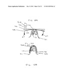 Catheter with Variable Attachment Means diagram and image