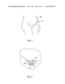Method and instrument for occlusion of uterine blood vessels diagram and image