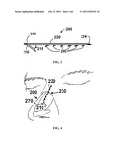 APPARATUS AND METHODS FOR CORRECTING NASAL VALVE COLLAPSE diagram and image