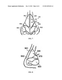 APPARATUS AND METHODS FOR CORRECTING NASAL VALVE COLLAPSE diagram and image