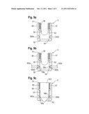 BONE ANCHORING DEVICE diagram and image