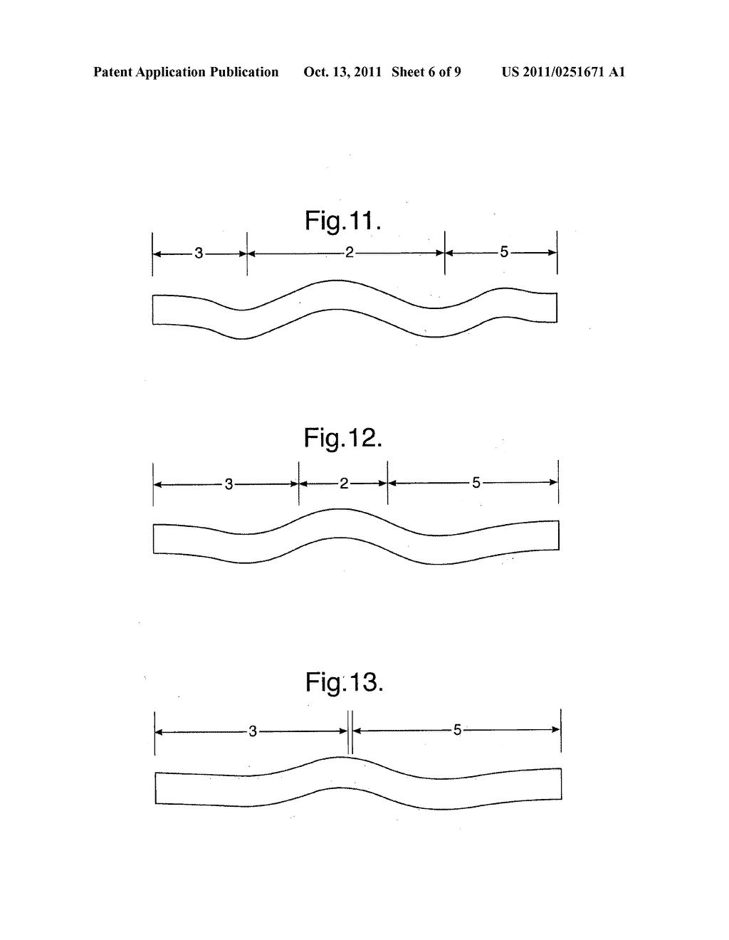 STENT SUITABLE FOR DEPLOYMENT IN A BLOOD VESSEL - diagram, schematic, and image 07