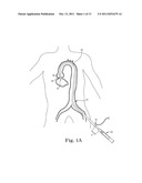 Transcatheter Prosthetic Heart Valve Delivery System and Method With     Stretchable Stability Tube diagram and image