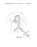 Transcatheter Prosthetic Heart Valve Delivery System and Method With     Stretchable Stability Tube diagram and image