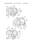DEVICES, SYSTEMS, AND METHODS FOR RESHAPING A HEART VALVE ANNULUS diagram and image