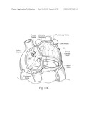 DEVICES, SYSTEMS, AND METHODS FOR RESHAPING A HEART VALVE ANNULUS diagram and image