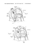 DEVICES, SYSTEMS, AND METHODS FOR RESHAPING A HEART VALVE ANNULUS diagram and image