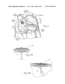 DEVICES, SYSTEMS, AND METHODS FOR RESHAPING A HEART VALVE ANNULUS diagram and image