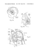 DEVICES, SYSTEMS, AND METHODS FOR RESHAPING A HEART VALVE ANNULUS diagram and image