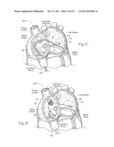 DEVICES, SYSTEMS, AND METHODS FOR RESHAPING A HEART VALVE ANNULUS diagram and image