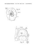 DEVICES, SYSTEMS, AND METHODS FOR RESHAPING A HEART VALVE ANNULUS diagram and image