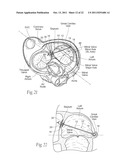 DEVICES, SYSTEMS, AND METHODS FOR RESHAPING A HEART VALVE ANNULUS diagram and image