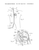 DEVICES, SYSTEMS, AND METHODS FOR RESHAPING A HEART VALVE ANNULUS diagram and image