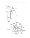 DEVICES, SYSTEMS, AND METHODS FOR RESHAPING A HEART VALVE ANNULUS diagram and image