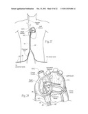 DEVICES, SYSTEMS, AND METHODS FOR RESHAPING A HEART VALVE ANNULUS diagram and image