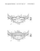 ANTI-DYSPHOTOPIC INTRAOCULAR LENS AND METHOD diagram and image