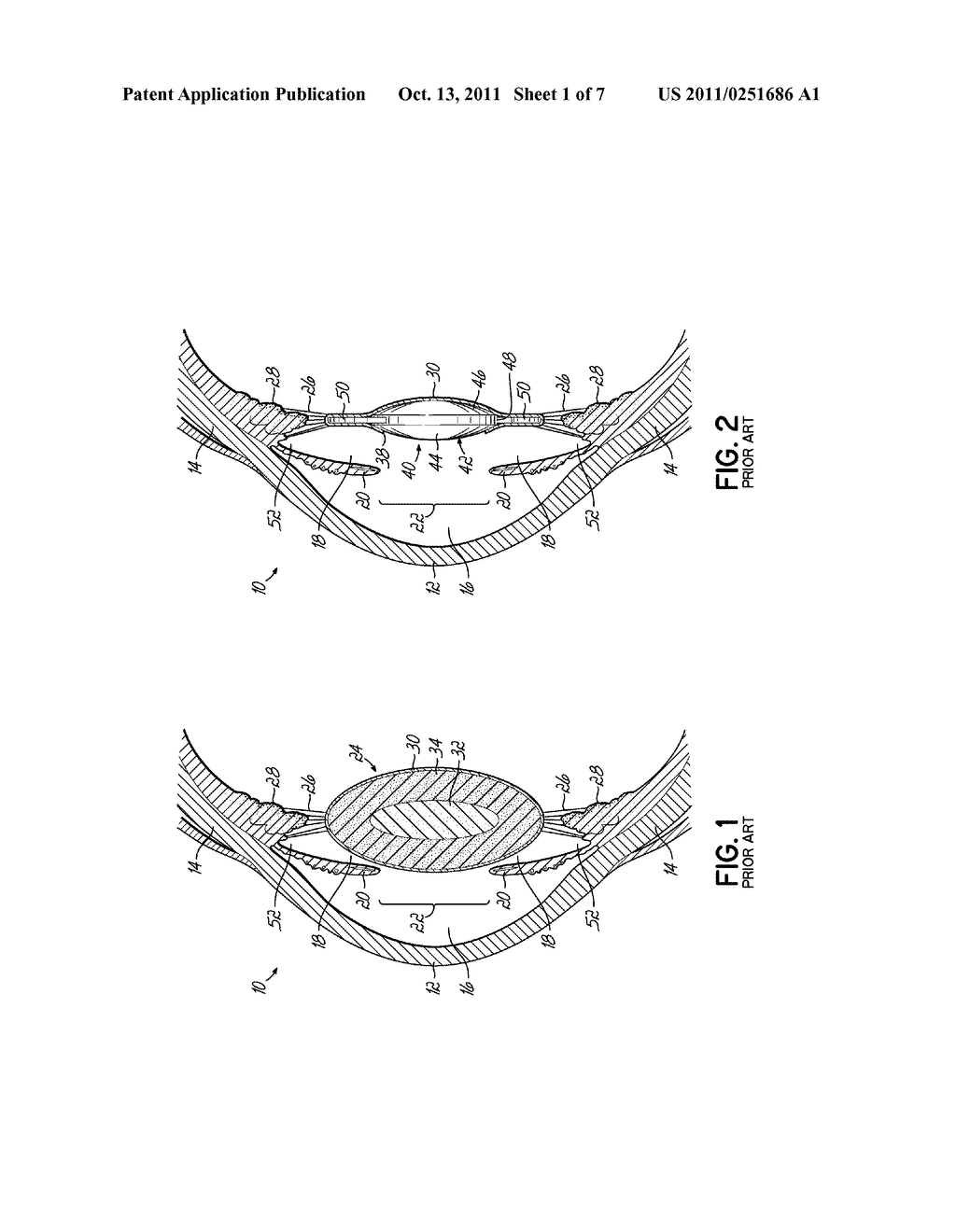 ANTI-DYSPHOTOPIC INTRAOCULAR LENS AND METHOD - diagram, schematic, and image 02