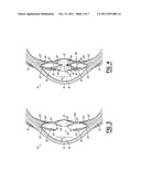 ANTI-DYSPHOTOPIC INTRAOCULAR LENS AND METHOD diagram and image