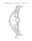 ANTI-DYSPHOTOPIC INTRAOCULAR LENS AND METHOD diagram and image