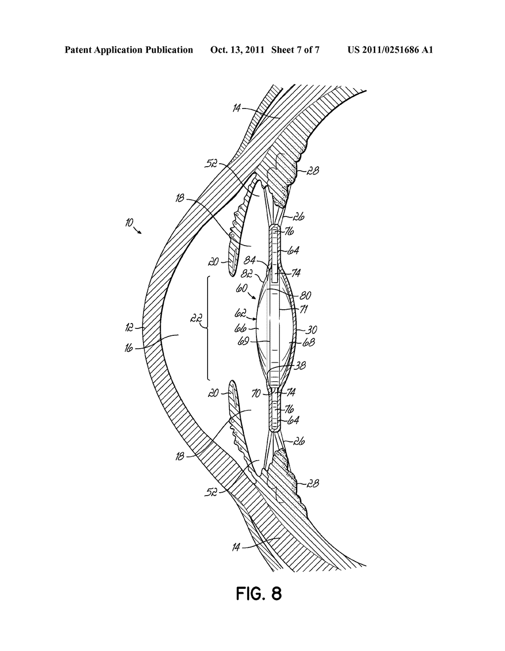 ANTI-DYSPHOTOPIC INTRAOCULAR LENS AND METHOD - diagram, schematic, and image 08