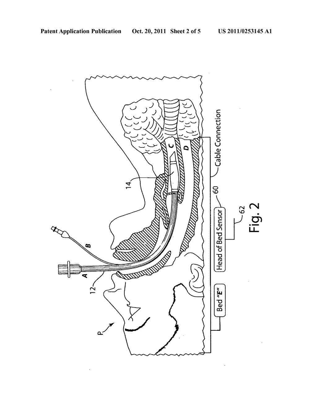 Pressurized tracheal cuff control arrangement - diagram, schematic, and image 03