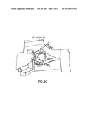 POSITIONING DEVICE FOR ANKLE JOINT REPLACEMENT SURGERY diagram and image