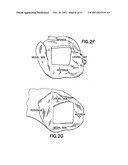 POSITIONING DEVICE FOR ANKLE JOINT REPLACEMENT SURGERY diagram and image