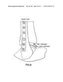 POSITIONING DEVICE FOR ANKLE JOINT REPLACEMENT SURGERY diagram and image