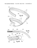 VENTRICULAR FUNCTION ASSISTING DEVICE AND A METHOD AND APPARATUS FOR     IMPLANTING IT diagram and image