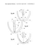 VENTRICULAR FUNCTION ASSISTING DEVICE AND A METHOD AND APPARATUS FOR     IMPLANTING IT diagram and image